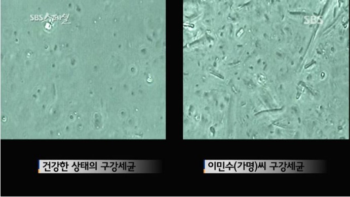 심한 입냄새로 이혼 당한 남자의 입냄새 고치는 SBS 다큐 | 인스티즈