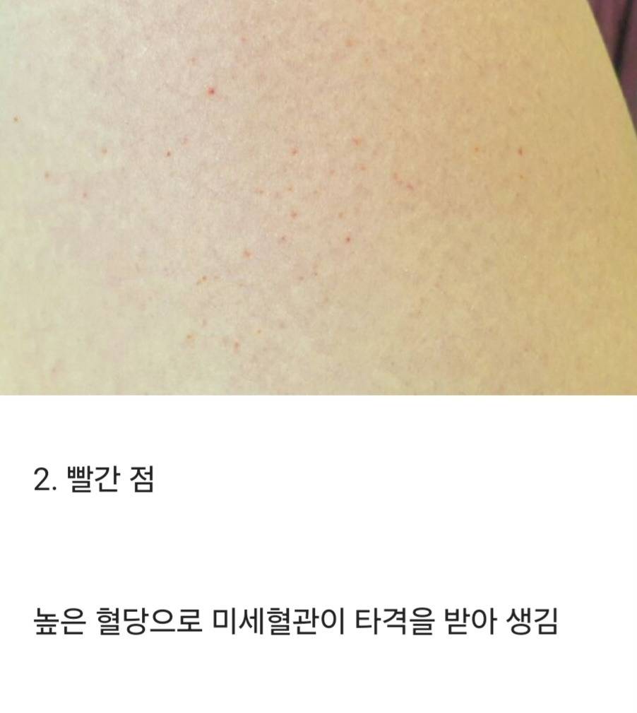 당뇨가 가까올때쯤 생긴다는 증상.jpg | 인스티즈