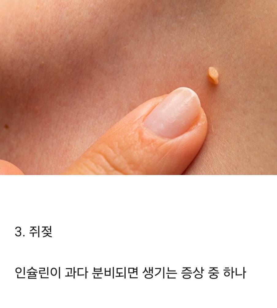 당뇨가 가까올때쯤 생긴다는 증상.jpg | 인스티즈