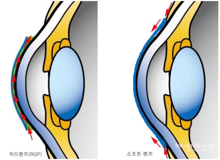 소프트렌즈와 하드렌즈의 비교...jpg | 인스티즈