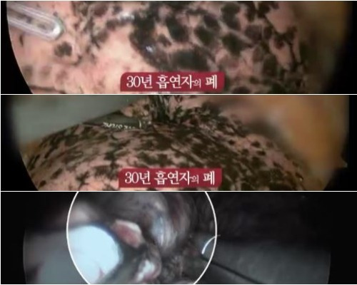 비흡연자, 간접흡연, 흡연자 폐 사진 | 인스티즈