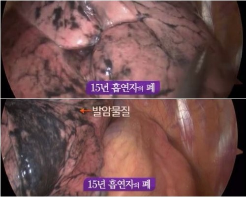 비흡연자, 간접흡연, 흡연자 폐 사진 | 인스티즈