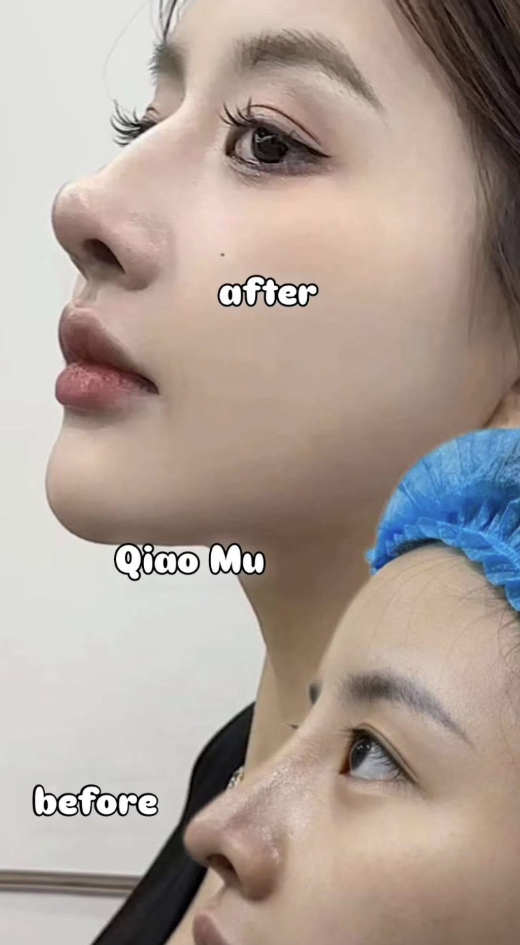 중국에서는 코 성형할 때 콧대 매끈하게 안 하고 일부러 좀 울퉁불퉁하게 한다더니 진짜인가 봄 twt | 인스티즈